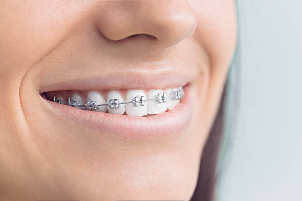 Dental Bonding in Lowell, MI